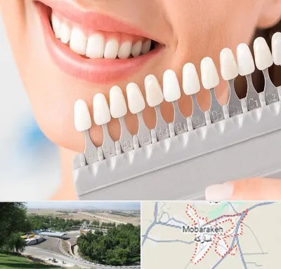 متخصص لمینت دندان در مبارکه