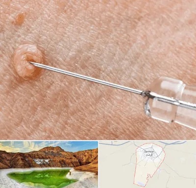 لیزر زگیل تناسلی در گرمسار