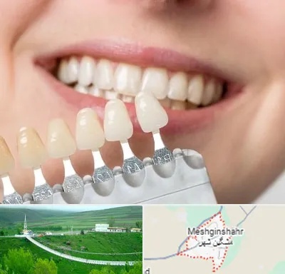 مرکز کامپوزیت دندان در مشگین شهر