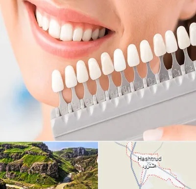 متخصص لمینت دندان در هشترود