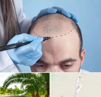 کاشت مو اقساطی در کهنوج