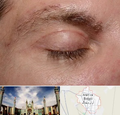 جراح بلفاروپلاستی در آران و بیدگل