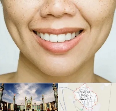عمل چال گونه در آران و بیدگل