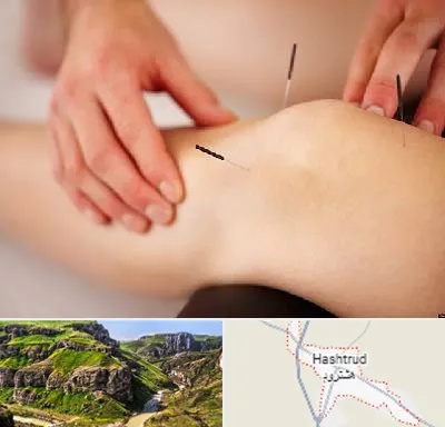 دکتر طب سوزنی برای لاغری در هشترود