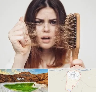 دکتر ریزش مو در گرمسار