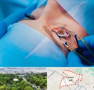 عمل prk چشم در البرز