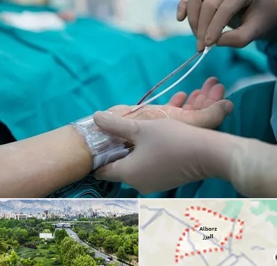 آنژیوگرافی در البرز