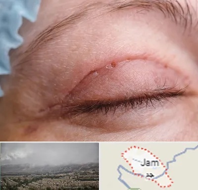 جراح پلک در جم