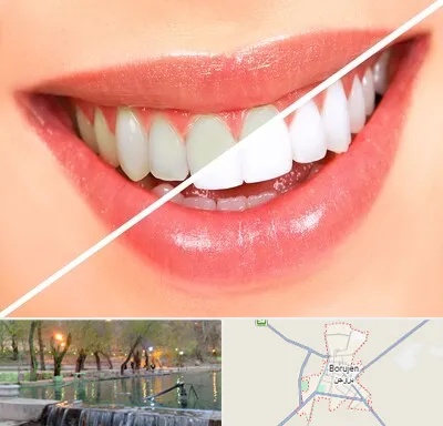 بلیچینگ دندان در بروجن