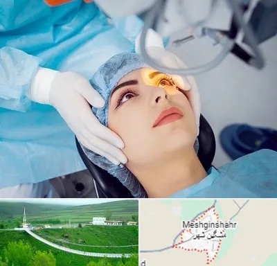 دکتر عمل لیزیک چشم در مشگین شهر