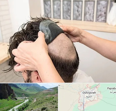 پروتز مو در اشنویه