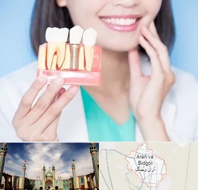 متخصص ایمپلنت در آران و بیدگل