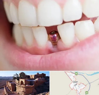 ایمپلنت اقساطی در قائن
