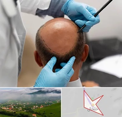 آموزش کاشت مو در خلخال