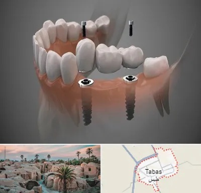 ایمپلنت دیجیتال در طبس