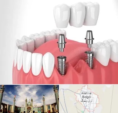 کاشت دندان در آران و بیدگل