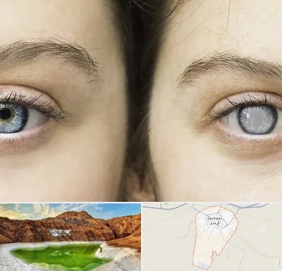 متخصص آب سیاه (گلوکوم) در گرمسار