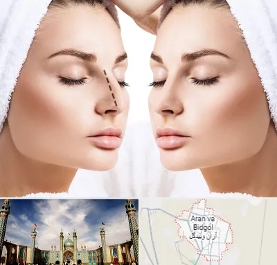 عمل بینی در آران و بیدگل