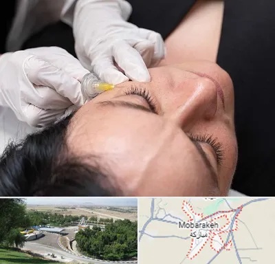 کربوکسی تراپی در مبارکه