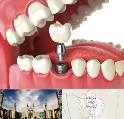 متخصص پروتز دندان در آران و بیدگل
