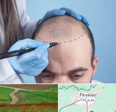 کاشت مو اقساطی در پارس آباد