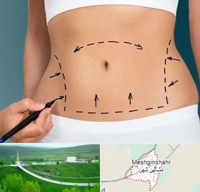 عمل ابدومینوپلاستی در مشگین شهر