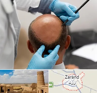 آموزش کاشت مو در زرند