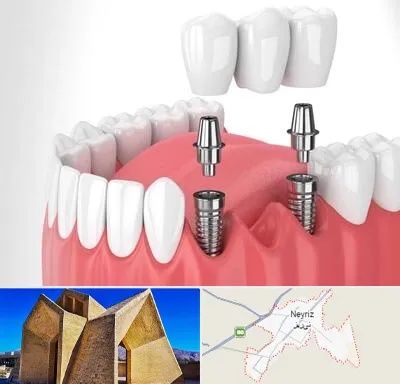 کاشت دندان در نی ریز