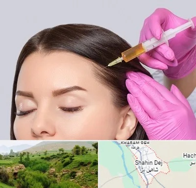تزریق هیر فیلر در شاهین دژ