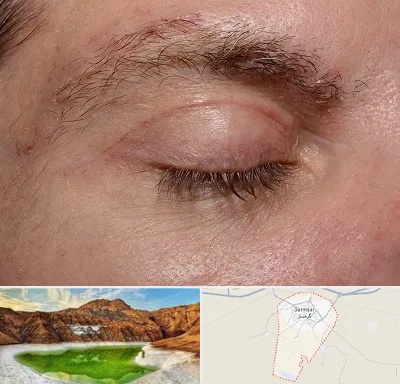 جراح بلفاروپلاستی در گرمسار