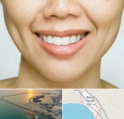 عمل چال گونه در بندر کنگان