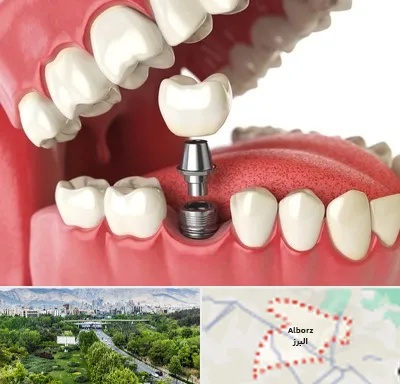متخصص پروتز دندان در البرز