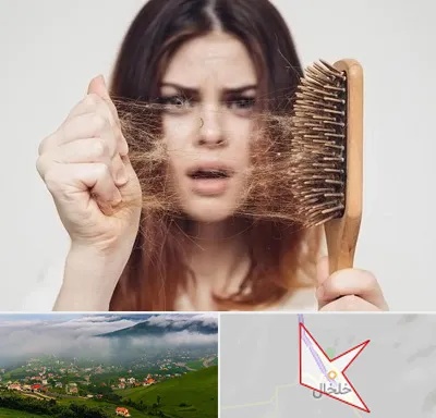 دکتر ریزش مو در خلخال