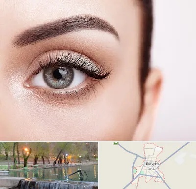 فوق تخصص عنبیه در بروجن