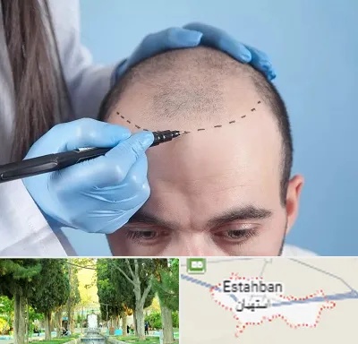کاشت مو اقساطی در استهبان