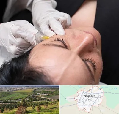 کربوکسی تراپی در نقده