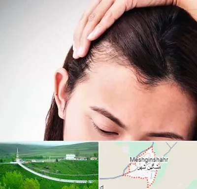 کاشت مو بانوان در مشگین شهر