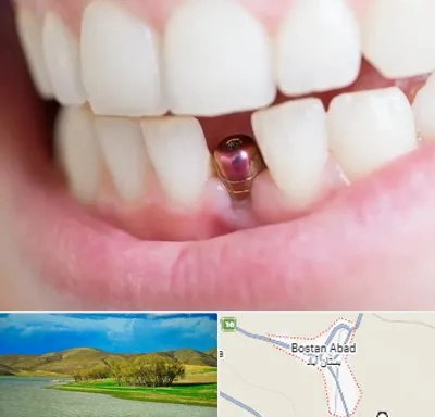ایمپلنت اقساطی در بستان آباد