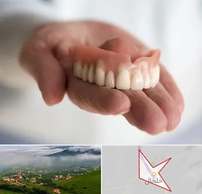لیفت لثه با لیزر در خلخال