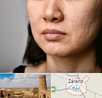 سابسیژن جای جوش در زرند