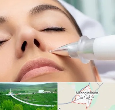 پلاسما جت بینی در مشگین شهر