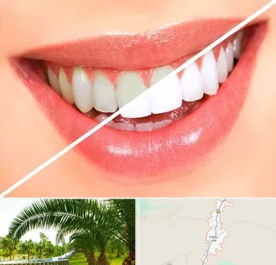 بلیچینگ دندان در کهنوج