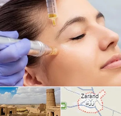 میکرونیدلینگ در زرند