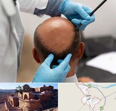 آموزش کاشت مو در قائن