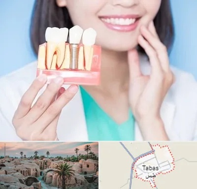 متخصص ایمپلنت در طبس
