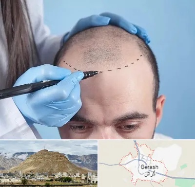 کاشت مو اقساطی در گراش