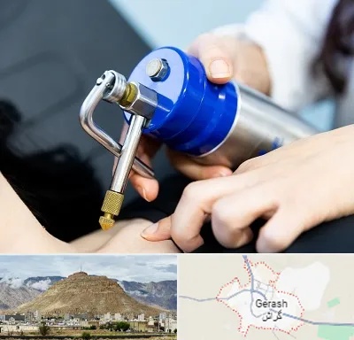 کرایوتراپی در گراش