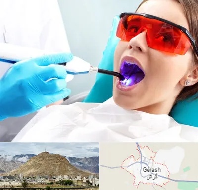 جراحی لثه با لیزر در گراش