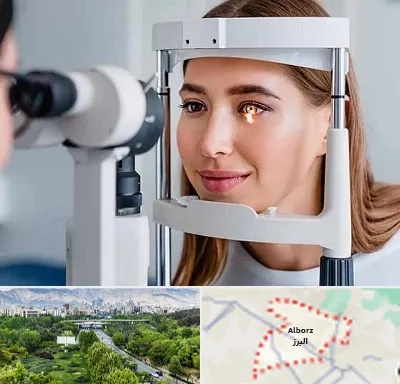 دکتر قوز قرنیه در البرز