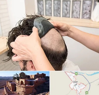 پروتز مو در قائن